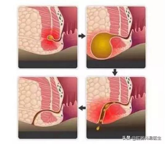 肛瘘是什么？该怎么合理预防呢？