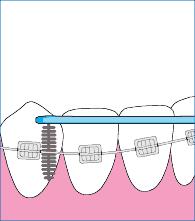 超详细的初戴正畸牙套的注意事项,戴全瓷牙套后需要注意什么