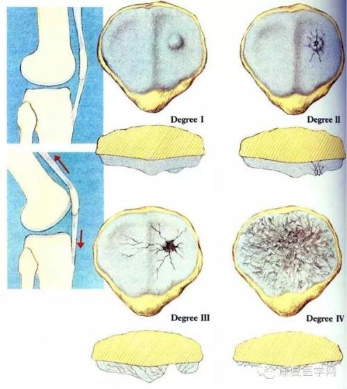 怎么查体判断髌骨软化,髌骨软化是发炎还是磨损