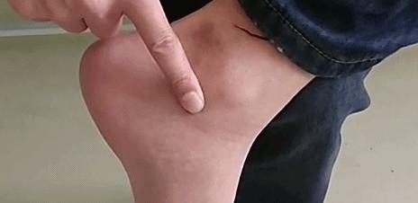 艾灸感到热和疼,艾灸时感觉很舒服