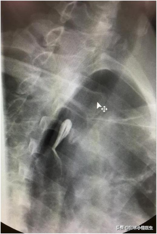 误吞假牙吃什么有助于排出,误吞假牙怎么处理