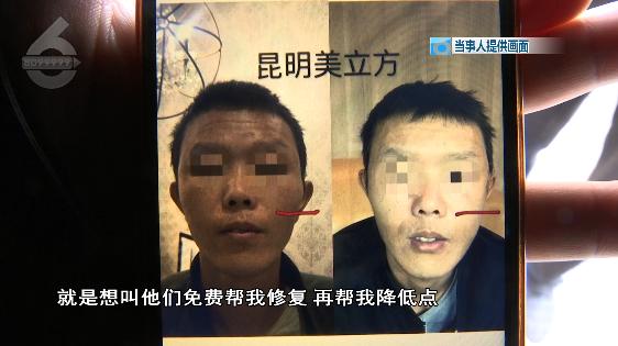 张嘴会响左右不对称!30岁小伙花三万“去颧骨”失败找院方协商还想再做手术