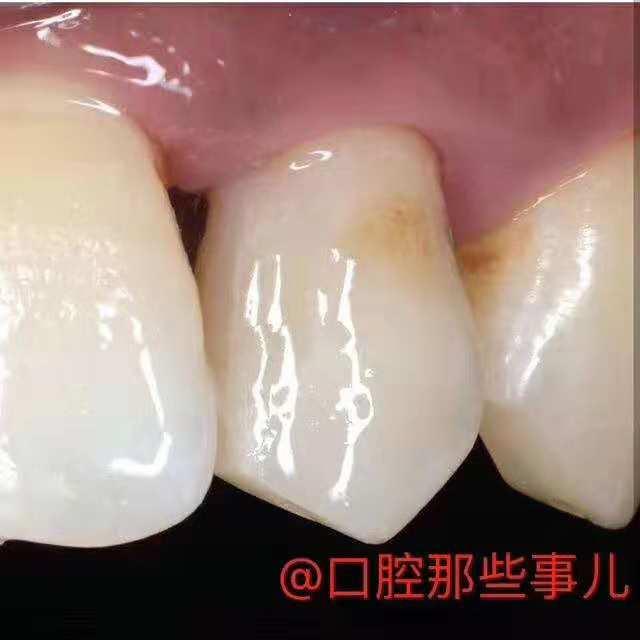 想要补个牙反而被磨了个大洞,大牙牙洞很大很深能补吗