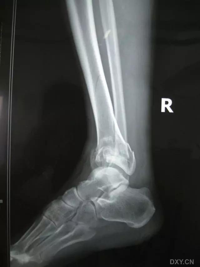 特殊骨折类型,特殊骨折体征