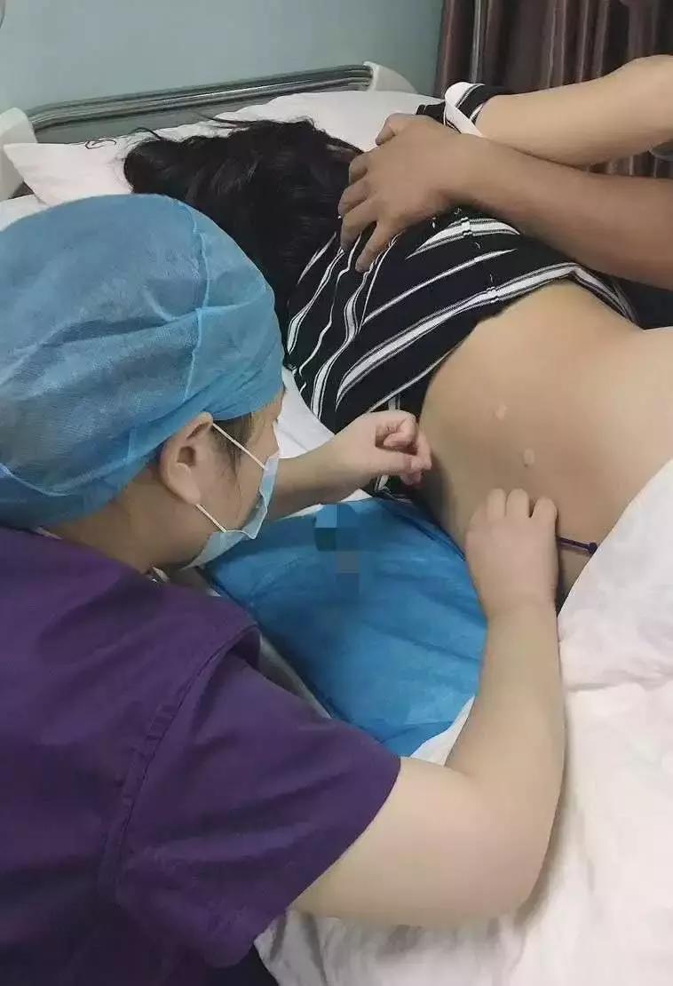 非药物性水针镇痛,缓解产程中腰酸腰痛的良方