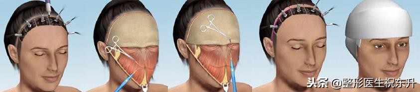 额颞部除皱去抬头纹怎么样,拉皮除皱抬头纹全过程视频