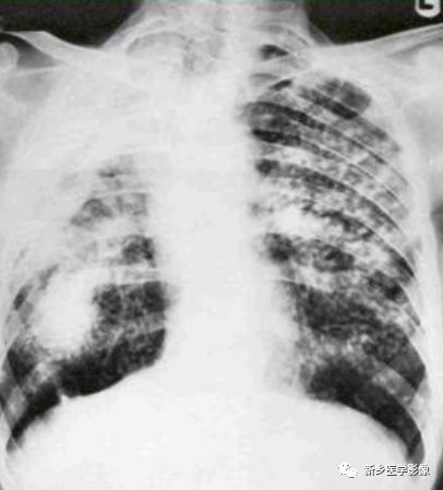 矽肺影像诊断报告,矽肺拍片什么症状