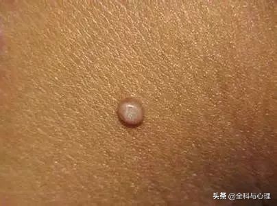 肛门有肿块，可能是这8种疾病！这些知识你要知道