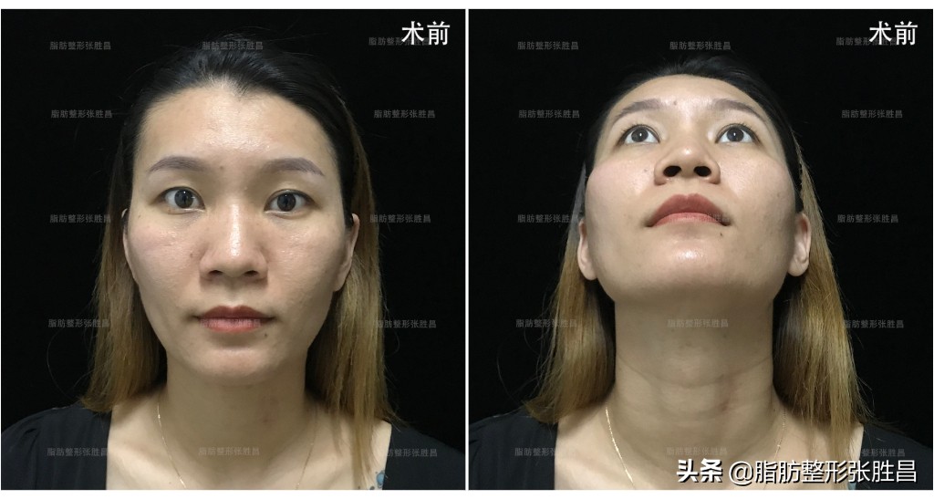 一块骨头把温柔脸变凶脸？她颧骨高如山，不经磨骨之痛却收获了美