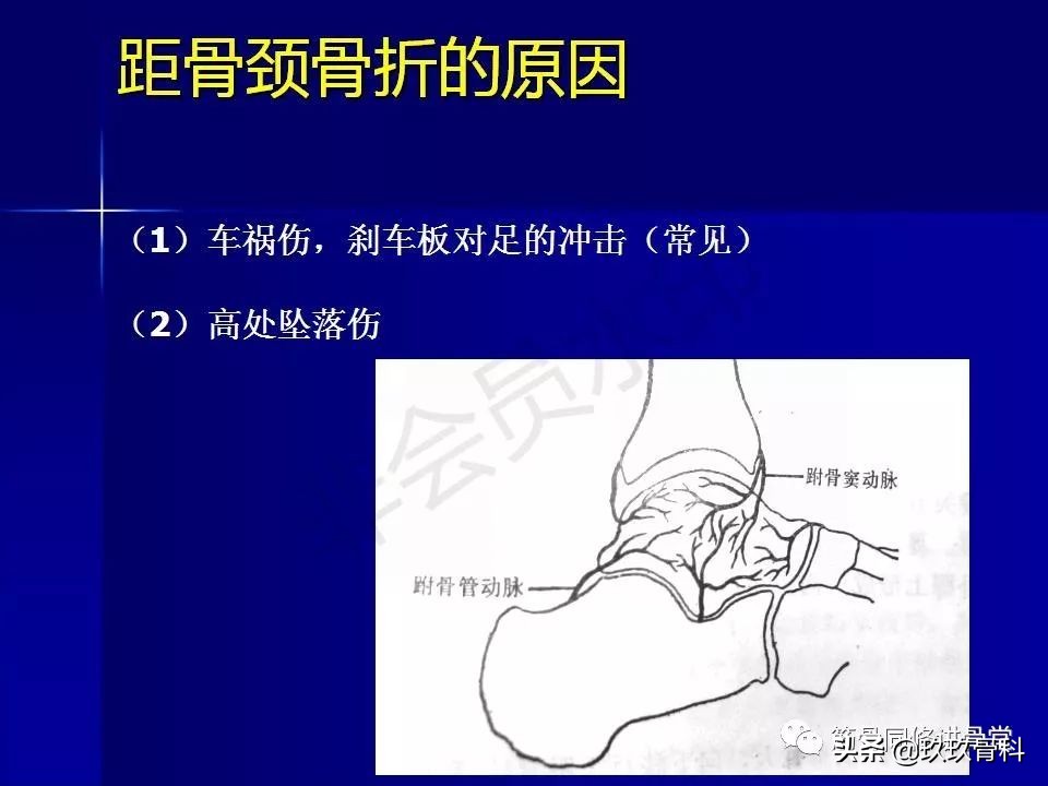 距骨骨折后遗症,距骨骨折怎么办