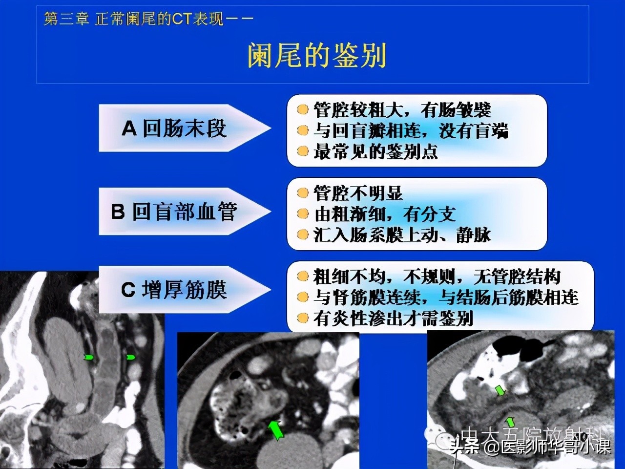 阑尾炎课件,阑尾炎的超声课件