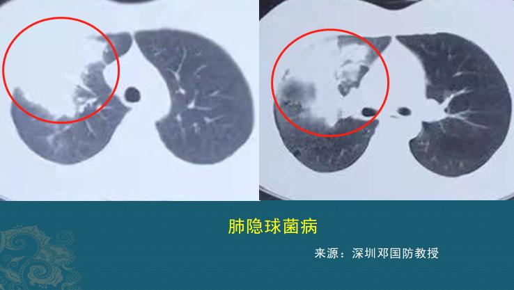 这种病菌1亿年前就有了，后来地球出现人类，它又学会了感染人肺