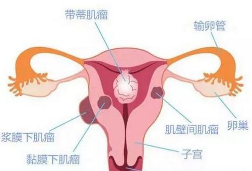 真菌性妇科炎症是什么原因造成的,得妇科炎症的主要原因是