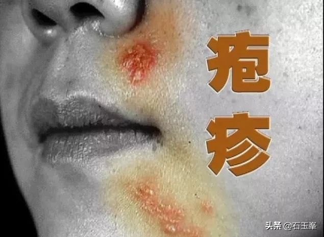 带状疱疹的水泡没了但还是很痒,带状疱疹水泡没了还会传染吗