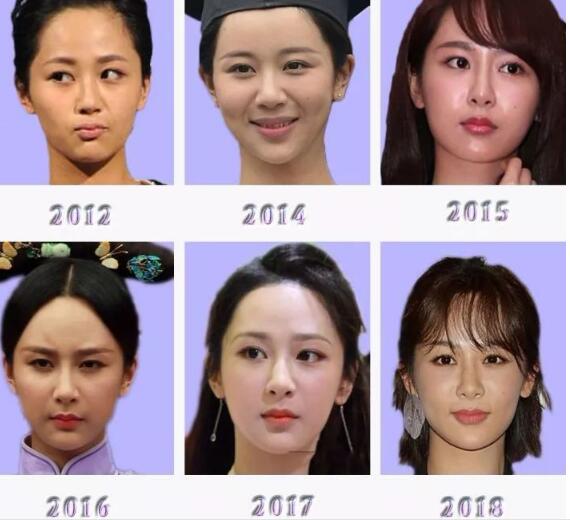 哪个明星做了颧骨内推,颧骨内推明星前后对比