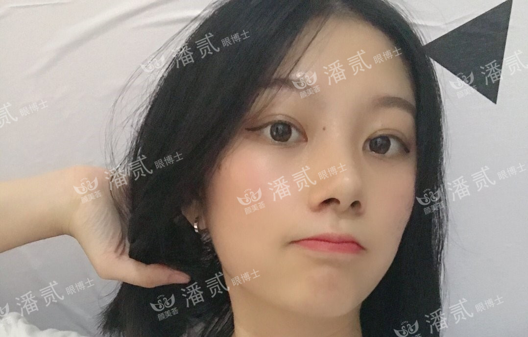 肿眼泡抽脂肪埋线双眼皮效果,肿眼泡割双眼皮长脂肪