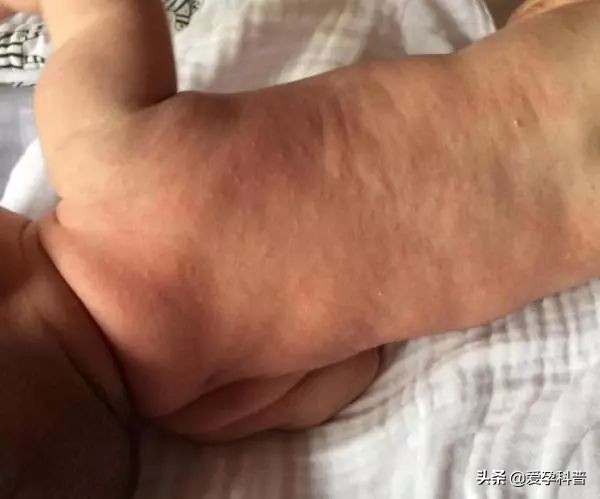 宝宝长湿疹是因为“胎毒”？家长若不做这4件事，湿疹就难治了