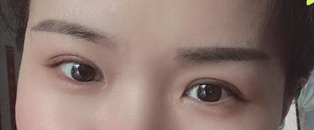 眼球突出割双眼皮好看吗,割双眼皮的危害