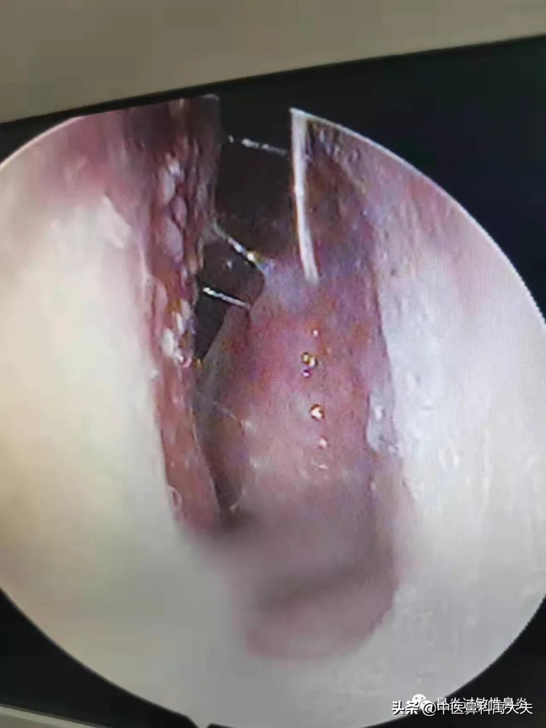 血管运动性鼻炎和过敏性鼻炎症状,鼻炎和过敏性鼻炎症状区别
