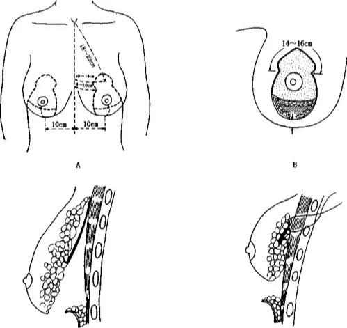 乳房下垂缩小整形,乳房缩小整形手术