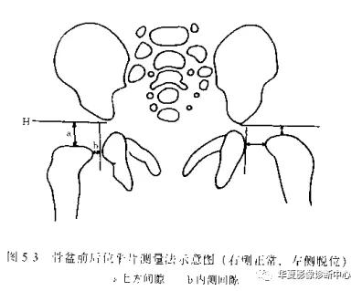 先天性髋关节脱位,先天性髋关节脱位属不属于残疾人