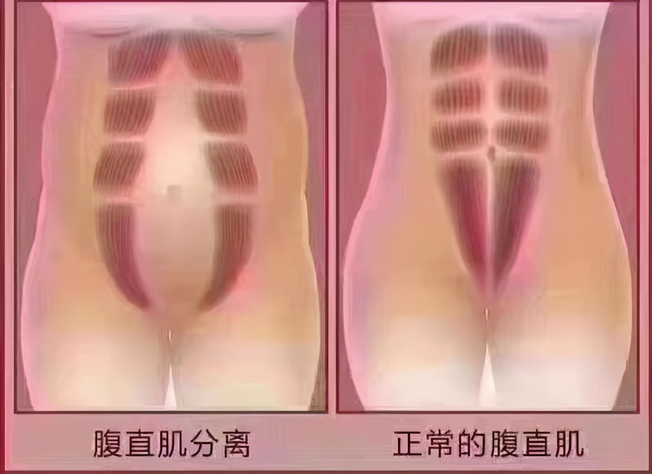 宝妈产后身体修复有哪些,宝妈的产后修复护理是什么