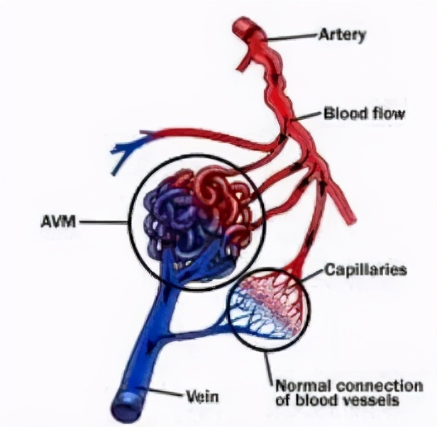 小脑血管畸形可以保守治疗吗,脑血管畸形出血保守治疗方法