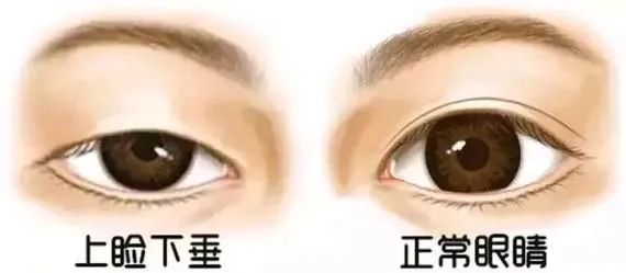下眼皮下垂是什么原因导致的,一只眼皮下垂什么原因
