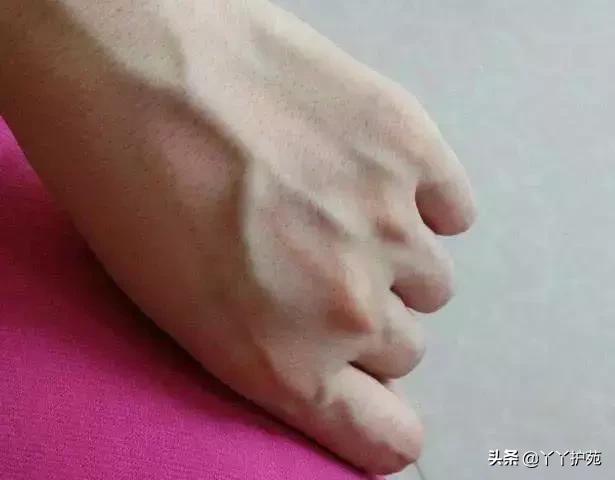 什么地方有青筋,这五个地方长痣要注意