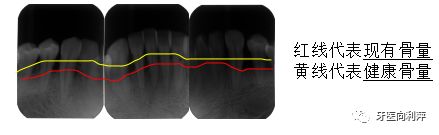 洗牙后为何会感觉牙缝变大了,洗牙后牙缝变大了怎么回事呢