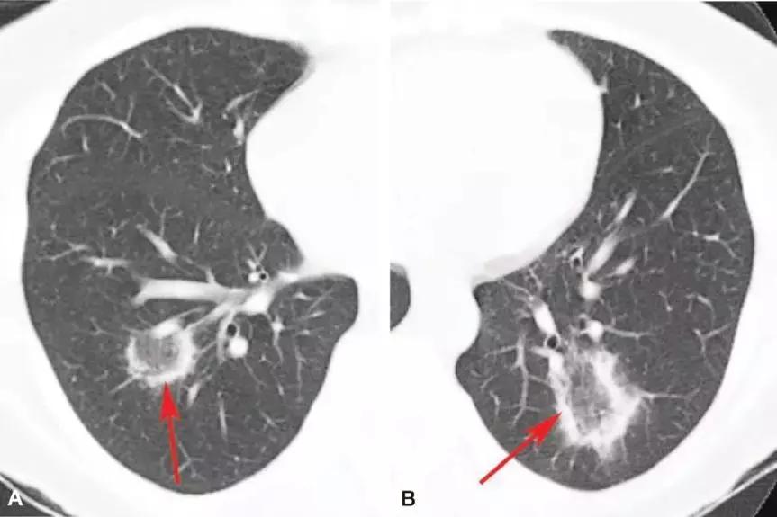 CACP2019:代华平:机化性肺炎的诊疗误区与防范