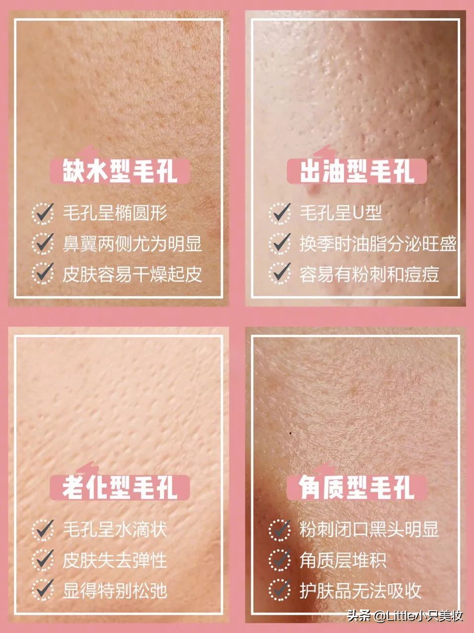 拯救小秘密,拯救毛孔粗大黑头粉刺