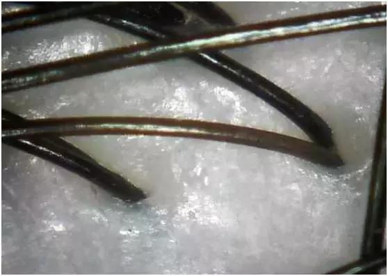 头皮清洁和头皮理疗的区别,头皮护理的意义是什么