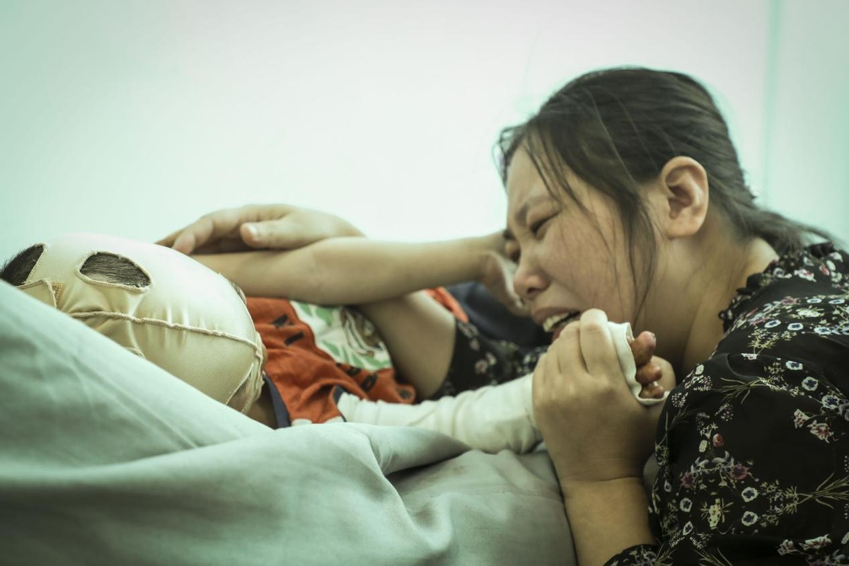 孩子被开水烫伤母亲却只心疼杯子,小孩掉进开水盆80%烫伤