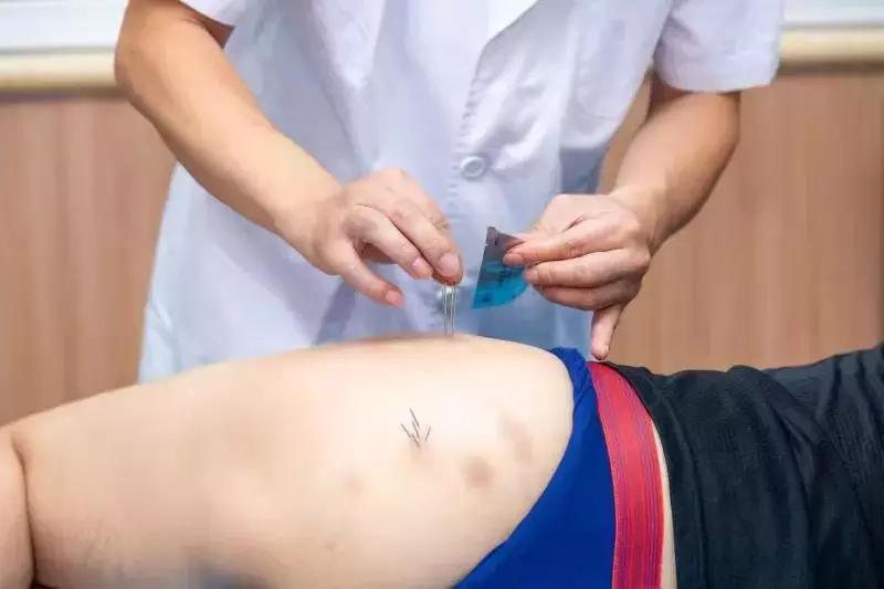 五虎擒羊是指什么穴位,五虎擒羊针法