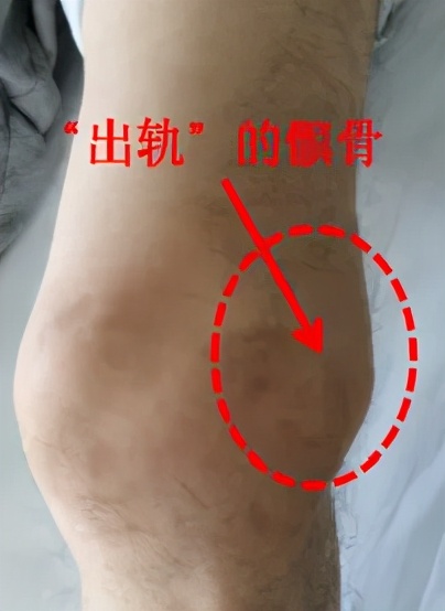 不同膝盖疼痛是暗示什么,不同位置的膝盖疼