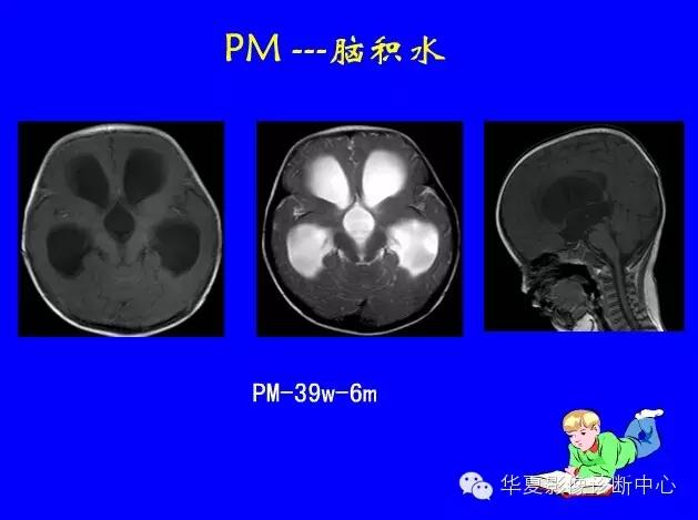 新生儿颅脑mri,新生儿颅脑mr报告模板