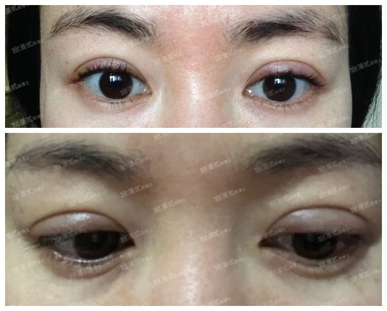 广州双眼皮修复内双,广州双眼皮修复可以只修眼尾吗