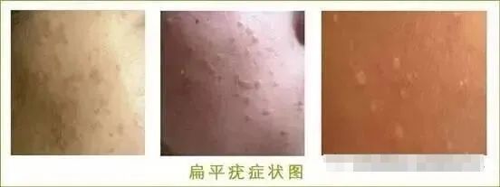 6岁儿童丝状疣怎么治疗,小孩子得寻常疣是什么原因造成的