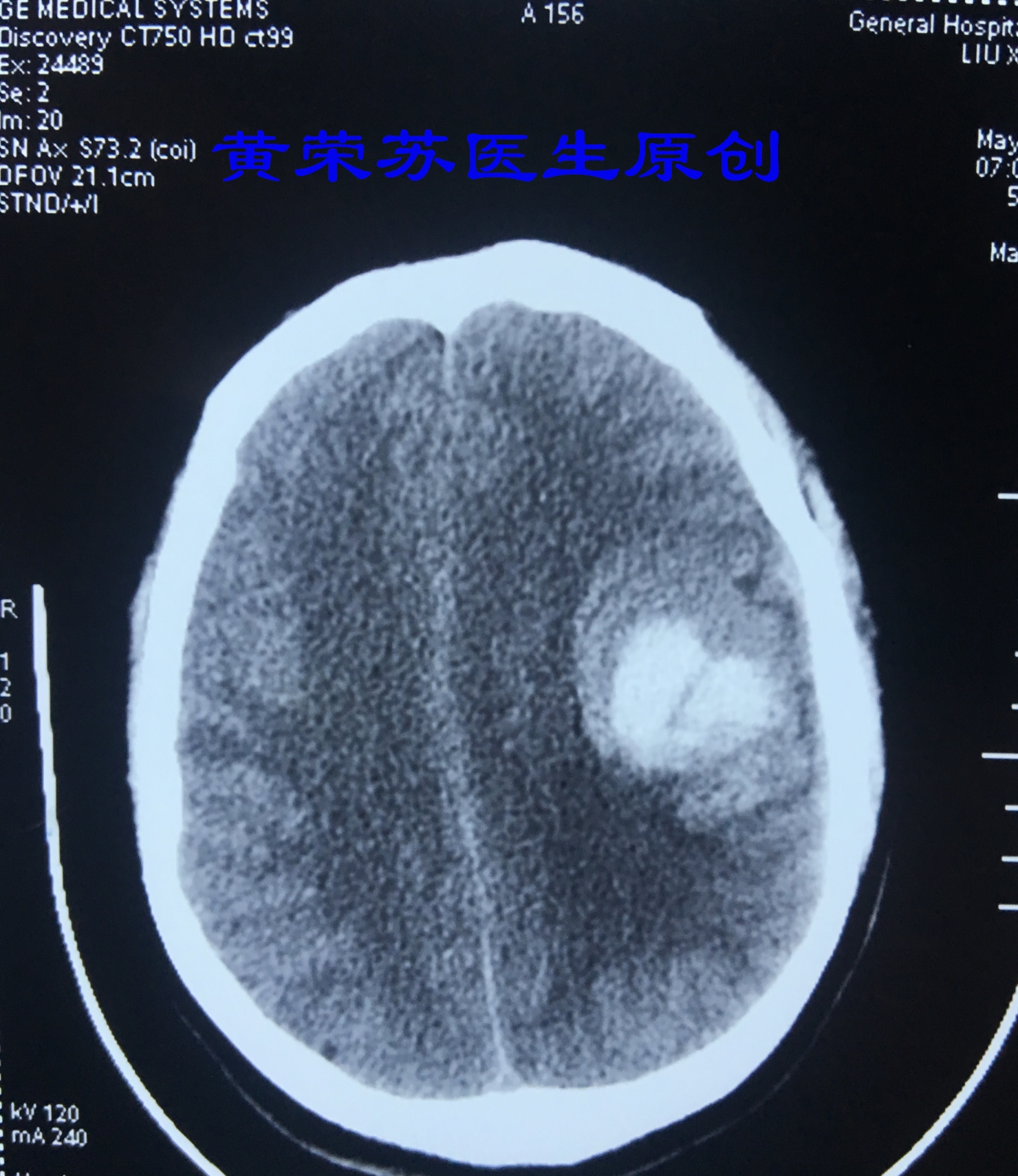脑出血症状科普动画视频,脑出血的出血部位脑细胞会坏死吗