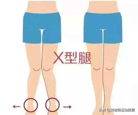x型腿膝盖伸不直怎么办,感觉腿不直怎么回事