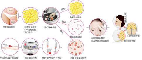 自体脂肪面部填充，让你的脂肪“动起来”