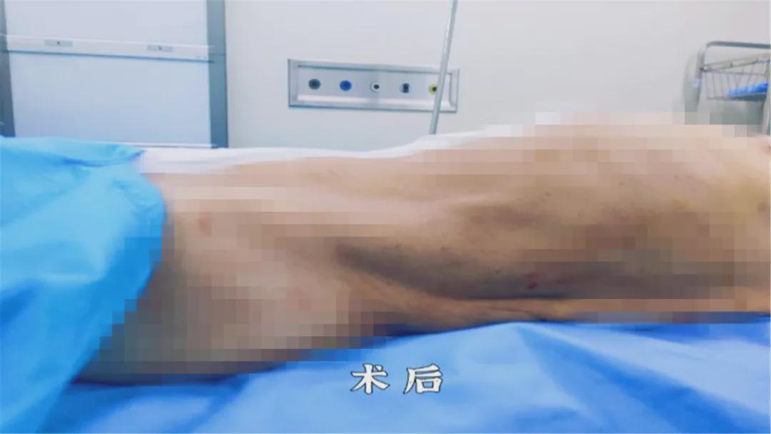 女子腹中取100斤重肿瘤,年轻女子查出大肌瘤