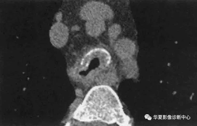 肺部代谢周期是多少天,肺部高代谢病变