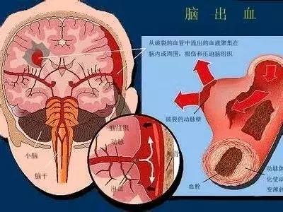 冷空气来袭慎防心脑血管病找上门,冷空气突袭