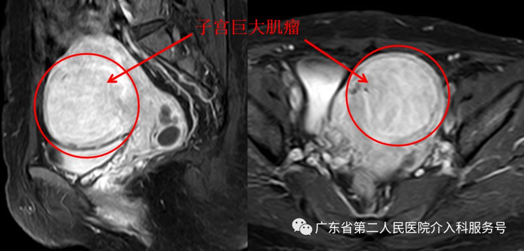 针眼妙方治疗，1个月后让淋沥不净的“大姨妈”如期结束