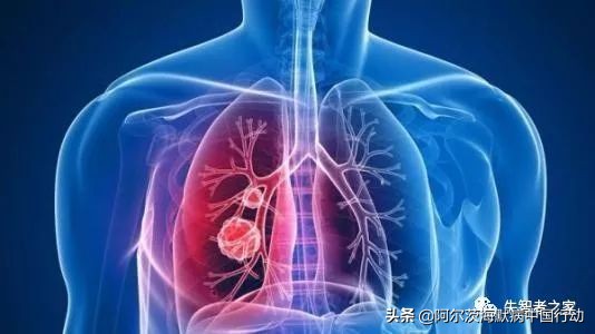 结肠癌晚期老年痴呆,晚期老人护理