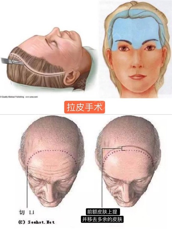 拉皮手术真人讲述案例,拉皮手术真实恢复期案例