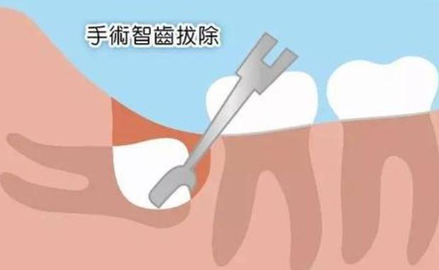 拔牙后出血的原因及处理办法,拔牙后出血严重会导致什么症状