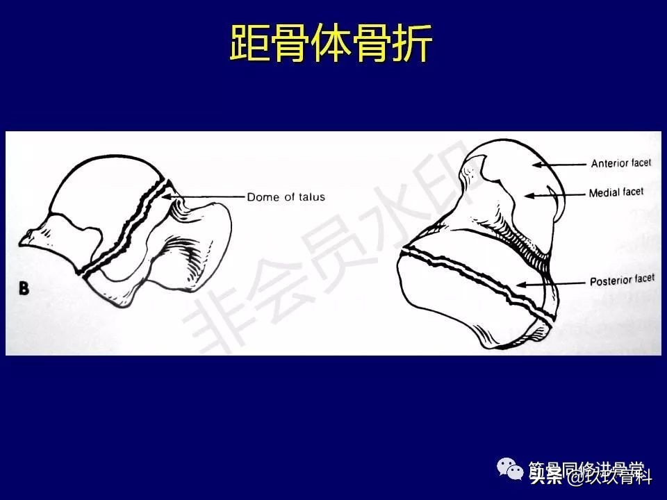 距骨骨折后遗症,距骨骨折怎么办